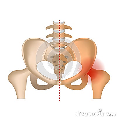 aseptic necrosis. Hip bone with damaged femoral head. Vector Illustration